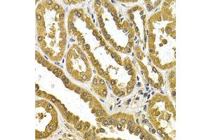 Immunohistochemistry of paraffin-embedded human kidney cancer using μgT1A4 antibody (ABIN5973231) at dilution of 1/200 (40x lens). (UGT1A4 Antikörper)