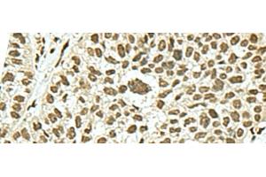 Immunohistochemistry of paraffin-embedded Human esophagus cancer tissue using KHSRP Polyclonal Antibody at dilution of 1:50(x200) (KHSRP Antikörper)