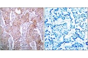 Immunohistochemistry analysis of paraffin-embedded human breast carcinoma, using EGFR (Phospho-Ser1070) Antibody.