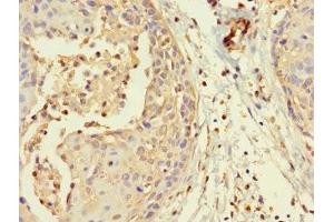 Immunohistochemistry of paraffin-embedded human cervical cancer using ABIN7160194 at dilution of 1:100