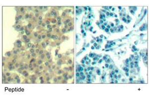 Immunohistochemical analysis of paraffin-embedded human breast carcinoma tissue using ERBB3 polyclonal antibody . (ERBB3 Antikörper  (Tyr1328))