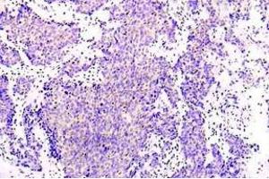 Immunohistochemistry (IHC) analysis of PRKAA1 antibody in paraffin-embedded human lung adenocarcinoma tissue. (PRKAA1 Antikörper)