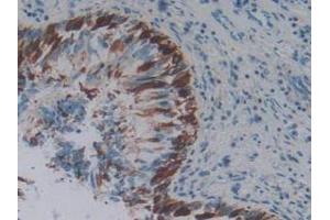 IHC-P analysis of Human Lung Cancer Tissue, with DAB staining. (PD-1 Antikörper  (AA 41-132))