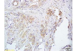 Formalin-fixed and paraffin embedded human cervical carcinoma labeled with Anti FUT8 Polyclonal Antibody, Unconjugated (ABIN716801) at 1:200 followed by conjugation to the secondary antibody and DAB staining (FUT8 Antikörper  (AA 311-410))
