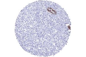 Immunohistochemistry (IHC) image for anti-Cadherin 1, Type 1, E-Cadherin (Epithelial) (CDH1) antibody (ABIN7477465)