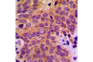 Immunohistochemical analysis of ASK1 staining in human breast cancer formalin fixed paraffin embedded tissue section.