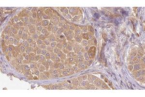 ABIN6272659 at 1/100 staining Human Melanoma tissue by IHC-P. (MFGE8 Antikörper  (C-Term))