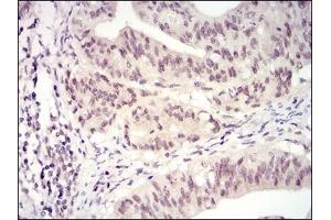 Immunohistochemical analysis of paraffin-embedded human rectum cancer tissues using CDK4 mouse mAb with DAB staining. (CDK4 Antikörper)