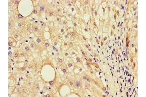 Immunohistochemistry of paraffin-embedded human liver cancer using ABIN7156880 at dilution of 1:100 (EBI3 Antikörper  (AA 21-227))