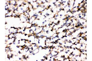 Anti- KCNIP2 Picoband antibody,IHC(P) IHC(P): Human Glioma Tissue (KCNIP2 Antikörper  (N-Term))