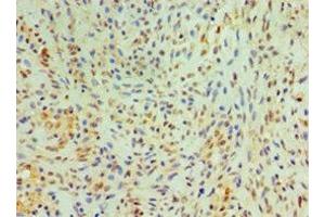 Immunohistochemistry of paraffin-embedded human breast cancer using ABIN7149005 at dilution of 1:100 (CST4 Antikörper  (AA 21-141))