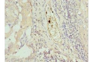Immunohistochemistry of paraffin-embedded human lung cancer using ABIN7172749 at dilution of 1:100 (Protein C8orf4 (TCIM) (AA 1-106) Antikörper)