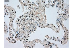 Immunohistochemical staining of paraffin-embedded Adenocarcinoma of breast tissue using anti-NTRK3 mouse monoclonal antibody. (NTRK3 Antikörper)