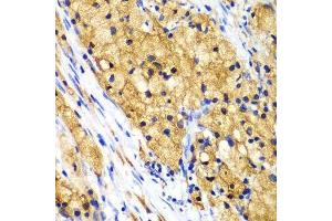 Immunohistochemistry of paraffin-embedded human lung cancer using CAPG Antibody. (CAPG Antikörper  (AA 1-348))