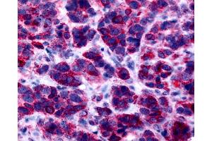 Anti-GPER1 / GPR30 antibody IHC of human breast, carcinoma. (GPER Antikörper  (Cytoplasmic Domain))