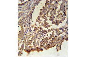 MC2R Antibody immunohistochemistry analysis in formalin fixed and paraffin embedded human skin carcinoma followed by peroxidase conjugation of the secondary antibody and DAB staining. (MC5 Receptor Antikörper  (C-Term))
