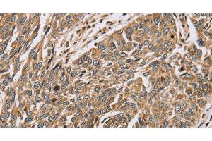 Immunohistochemistry of paraffin-embedded Human lung cancer using PTGER2 Polyclonal Antibody at dilution of 1:45 (PTGER2 Antikörper)