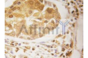 ABIN6269055 at 1/50 dilution staining IKB epsilon in human breast carcinoma by Immunohistochemistry using paraffin-embedded tissue (Survivin Antikörper  (Internal Region))
