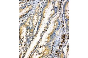 Anti-HEXA antibody, IHC(P) IHC(P):Human Intestinal Cancer Tissue (Hexosaminidase A Antikörper  (Middle Region))