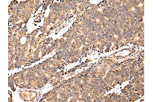 The image on the left is immunohistochemistry of paraffin-embedded Human prostate cancer tissue using ABIN7128064(UGGT2 Antibody) at dilution 1/20, on the right is treated with fusion protein. (UGCGL2 Antikörper)
