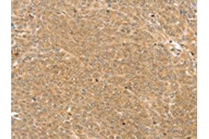 The image on the left is immunohistochemistry of paraffin-embedded Human ovarian cancer tissue using ABIN7192889(TRIM22 Antibody) at dilution 1/25, on the right is treated with synthetic peptide. (TRIM22 Antikörper)