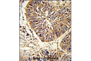 Formalin-fixed and paraffin-embedded human lung carcinoma reacted with PDIA3 Antibody , which was peroxidase-conjugated to the secondary antibody, followed by DAB staining. (PDIA3 Antikörper  (C-Term))