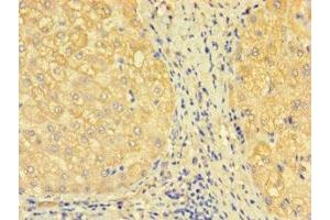 Immunohistochemistry of paraffin-embedded human liver tissue using ABIN7171277 at dilution of 1:100 (SDCBP2 Antikörper  (AA 11-207))