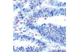 Immunohistochemistry of paraffin-embedded human colon carcinoma using PTBP1 Rabbit mAb (ABIN7269464) at dilution of 1:100 (40x lens). (PTBP1 Antikörper)