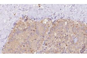 ABIN6273327 at 1/100 staining Human thyroid cancer tissue by IHC-P.