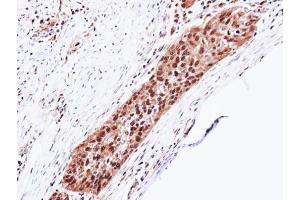 IHC-P Image Immunohistochemical analysis of paraffin-embedded H1299 xenograft, using Proteasome 20S alpha 5, antibody at 1:100 dilution. (PSMA5 Antikörper  (Center))