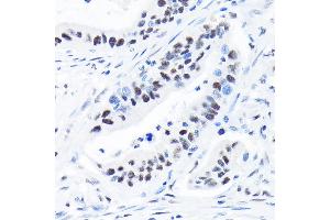 Immunohistochemistry of paraffin-embedded human colon carcinoma using SUPT5H/SPT5 Rabbit mAb (ABIN7270878) at dilution of 1:100 (40x lens). (SUPT5H Antikörper)