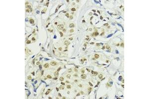 Immunohistochemistry of paraffin-embedded human mammary cancer using BA antibody (ABIN7265937) at dilution of 1:200 (40x lens). (BAZ2A Antikörper)