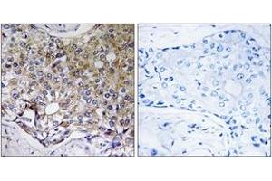 Immunohistochemistry analysis of paraffin-embedded human breast carcinoma tissue, using ATG4A Antibody. (ATG4A Antikörper  (AA 81-130))