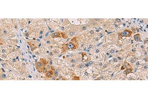 Immunohistochemistry of paraffin-embedded Human liver cancer tissue using RMDN2 Polyclonal Antibody at dilution of 1:50(x200)