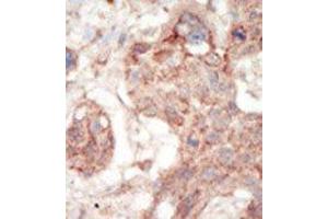Formalin-fixed and paraffin-embedded human cancer tissue reacted with the primary antibody, which was peroxidase-conjugated to the secondary antibody, followed by AEC staining. (FLT3 Antikörper  (C-Term))