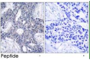 Immunohistochemical analysis of paraffin-embedded human breast carcinoma tissue using ZAP70 polyclonal antibody  . (ZAP70 Antikörper)