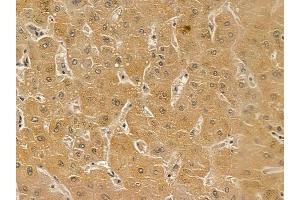 Estrogen-induced gene 121 protein Mouse Monoclonal Antibody at 1/100 staining human liver cancer by IHC-P. (ELAPOR1 Antikörper)
