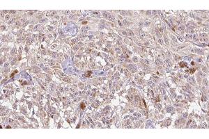 ABIN6268692 at 1/100 staining Human Melanoma tissue by IHC-P. (IL-8 Antikörper  (Internal Region))