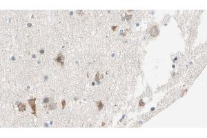 ABIN6274542 at 1/100 staining Human brain cancer tissue by IHC-P. (SHPK Antikörper  (N-Term))