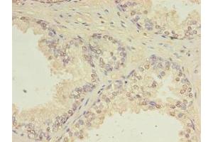 Immunohistochemistry of paraffin-embedded human prostate cancer using ABIN7147411 at dilution of 1:100 (CEP63 Antikörper  (AA 1-495))