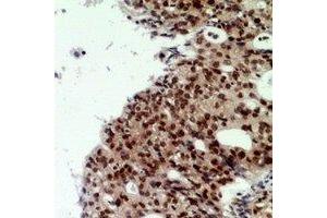 Immunohistochemical analysis of CNOT7 staining in human ovarian cancer formalin fixed paraffin embedded tissue section. (CNOT7 Antikörper  (N-Term))