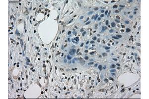 Immunohistochemical staining of paraffin-embedded Adenocarcinoma of colon tissue using anti-STAT1mouse monoclonal antibody. (STAT1 Antikörper)