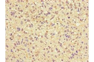 Immunohistochemistry of paraffin-embedded human glioma using ABIN7166372 at dilution of 1:100 (ZNF365 Antikörper  (AA 241-401))