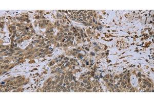 Immunohistochemistry of paraffin-embedded Human cervical cancer tissue using DCTN4 Polyclonal Antibody at dilution 1:50 (Dynactin 4 Antikörper)