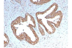 Formalin-fixed, paraffin-embedded human Prostate Carcinoma stained with COX-2 Recombinant Rabbit Monoclonal Antibody (COX2/3232R). (Rekombinanter PTGS2 Antikörper  (AA 442-572))