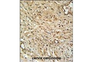 R Antibody (C-term) (ABIN651453 and ABIN2840247) immunohistochemistry analysis in formalin fixed and paraffin embedded human cervix carcinoma followed by peroxidase conjugation of the secondary antibody and DAB staining. (TWIST Neighbor Antikörper  (C-Term))