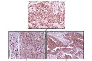 Immunohistochemical analysis of paraffin-embedded human pancreas carcinoma (A), esophagus carcinoma tissue (B) and ovary tumor tissue, showing cytoplasmic and membrane localization using 4E-BP1 antibody with DAB staining. (eIF4EBP1 Antikörper)