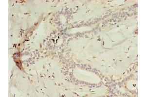 Immunohistochemistry of paraffin-embedded human breast cancer using ABIN7158845 at dilution of 1:100 (m-AAA Protease-Interacting Protein 1, Mitochondrial (MAIP1) (AA 97-291) Antikörper)