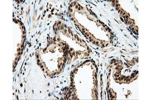 Immunohistochemical staining of paraffin-embedded Carcinoma of liver tissue using anti-LIPG mouse monoclonal antibody. (LIPG Antikörper)