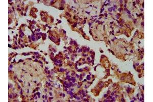 IHC image of ABIN7158078 diluted at 1:200 and staining in paraffin-embedded human lung cancer performed on a Leica BondTM system.